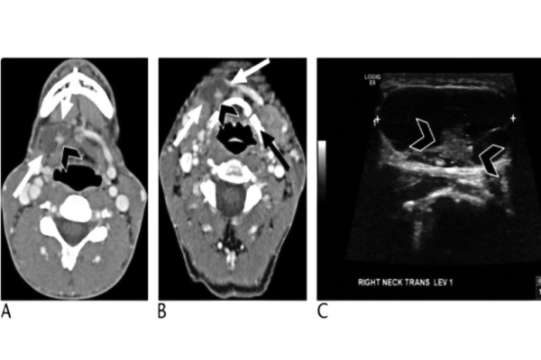 Jasim and colleagues discuss the significance of thyroglossal duct cysts in thyroid cancer imaging 